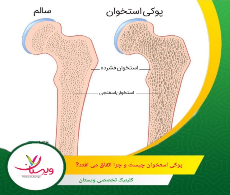 با غربالگری بهموقع، تغذیه مناسب، فعالیت بدنی منظم و اقدامات درمانی مؤثر، میتوان روند پیشرفت آن را کند کرد و حتی در مواردی متوقف ساخت. پوکی استخوان چیست و چرا اتفاق میافتد؟