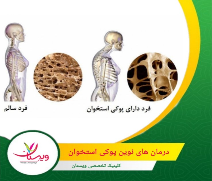درمانهای ژنتیکی و RNA محور برای مهار ژنهای مؤثر در پوکی استخوان وارد فاز بالینی شدهاند. درمانهای نوین پوکی استخوان در دنیا (2025)