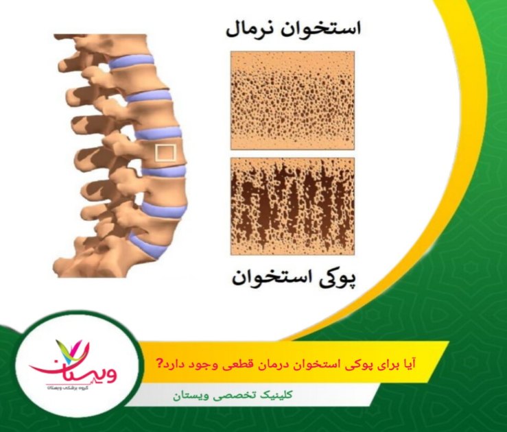 اصلاح سبک زندگی با تغذیه غنی از کلسیم، ویتامین D، ورزشهای تحمل وزن مانند پیادهروی و پرهیز از الکل و دخانیات. آیا درمان قطعی برای پوکی استخوان وجود دارد؟