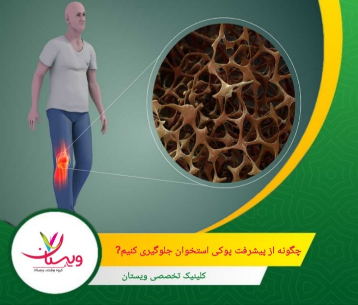 نیکوتین و الکل جذب کلسیم را مختل کرده و تراکم استخوان را کاهش میدهند. ترک آنها از توصیههای کلیدی CDC است. چگونه از پیشرفت پوکی استخوان جلوگیری کنیم؟