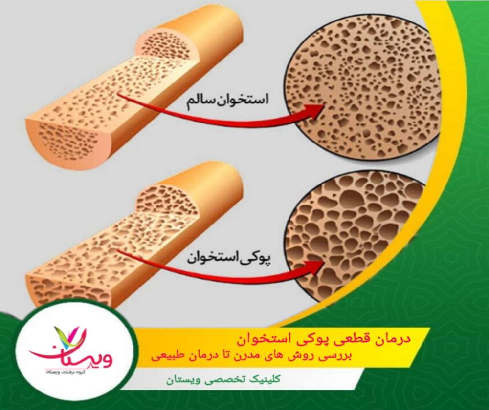 درمان قطعی پوکی استخوان| بررسی روشهای مدرن تا درمان طبیعی