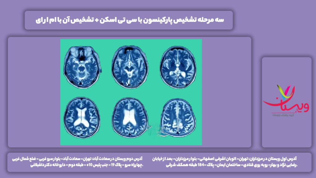 تشخیص پارکینسون با سی تی اسکن