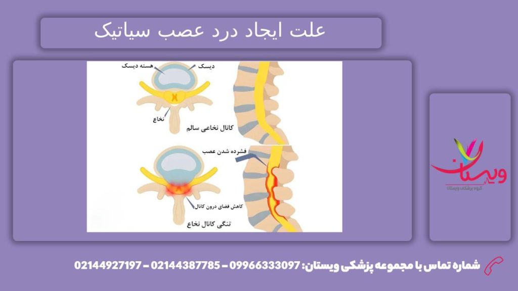 بوجود امدن درد عصب سیاتیک 5 تا از علت مهم درد بیماری عصب سیاتیک