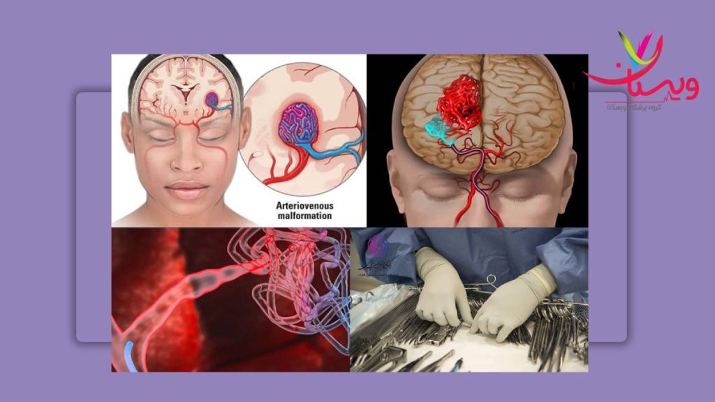 DVA یا ناهنجاری وریدی مغز ناهنجاری Dva مغزی