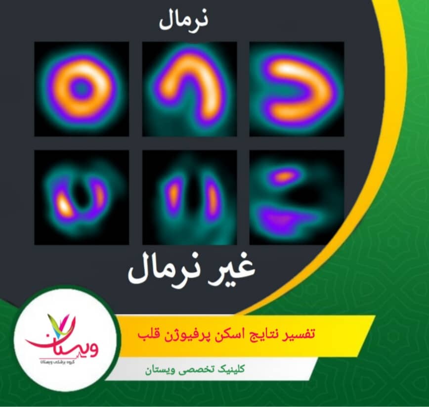 شدت و وسعت نواحی با خونرسانی کم نشاندهنده میزان وخامت بیماری است. تفسیر نتایج اسکن پرفیوژن قلب