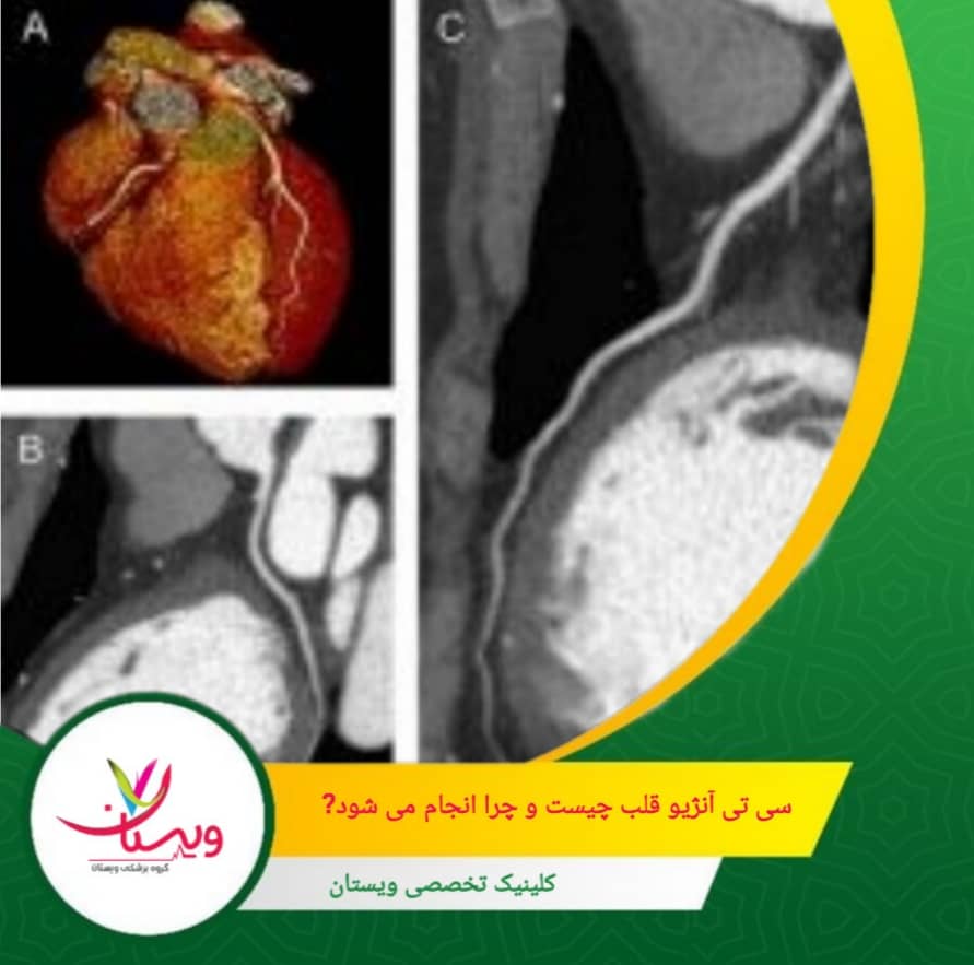 در این روش، با تزریق ماده حاجب از طریق ورید و انجام اسکن با دستگاه سیتی، تصاویر سهبعدی و با کیفیت بالا از رگهای خونی قلب تهیه میشود. سی تی آنژیو قلب چیست و چرا انجام میشود؟