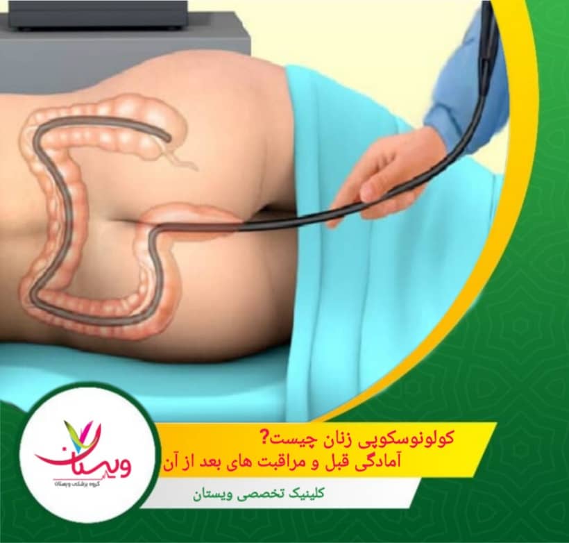 کولونوسکوپی زنان چیست؟| آمادگی قبل و مراقبت های بعد از آن