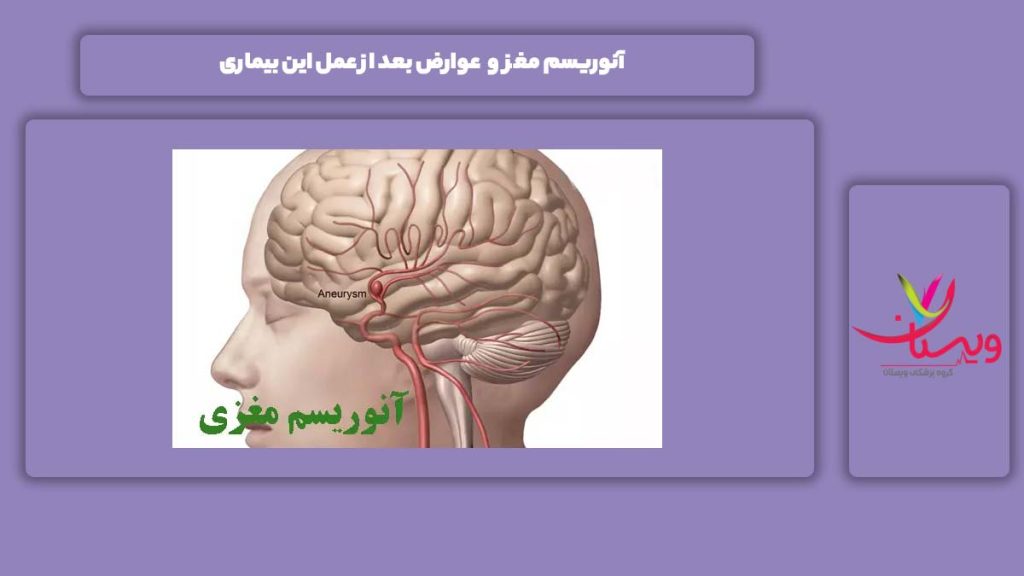 آنوریسم مغز