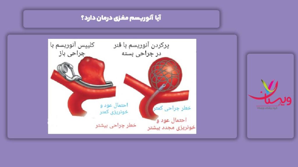 علاج و درمان بیماری آنوریسم مغزی درمان بیماری آنوریسم مغزی