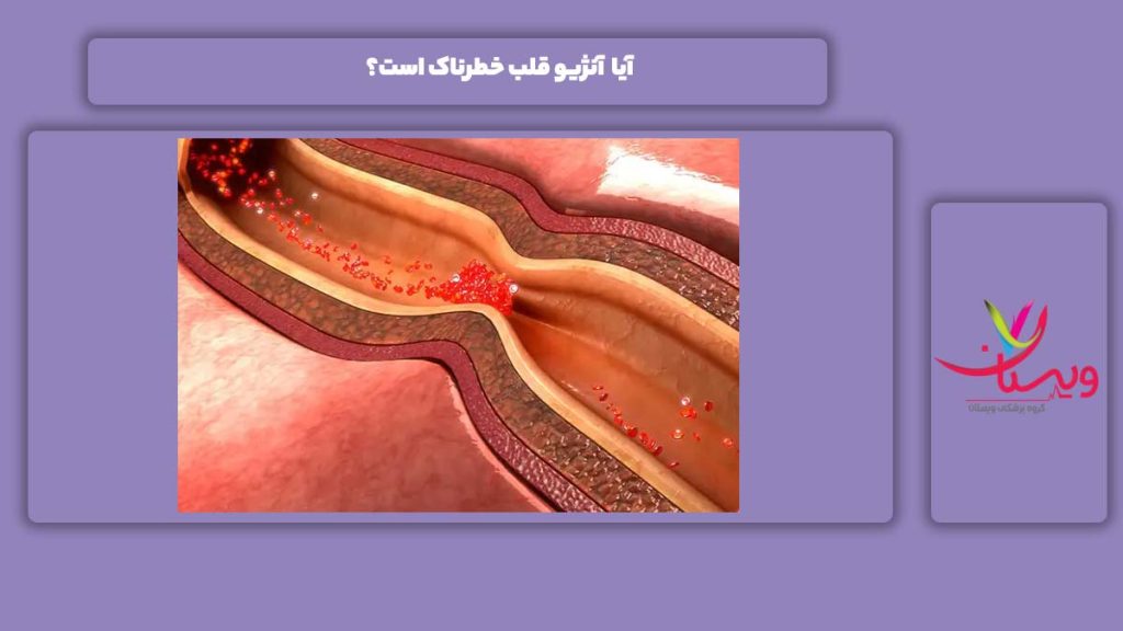 خطرناک نبودن آنژیو قلب آیا آنژیو قلب خطرناک است؟