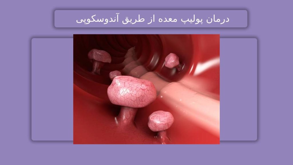درمان پولیپ معده راهکاری برای بهبود پولیپ معده از طریق آندوسکوپی