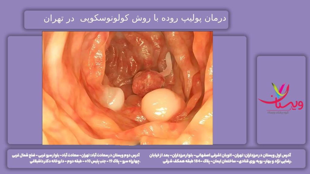 برداشتن پولیپ روده با کولونوسکوپی در مرکز تهران