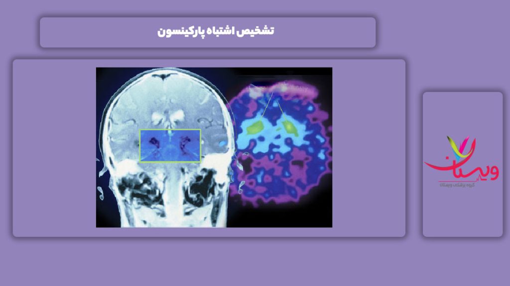 تشخیص اشتباه بیماری پارکینسون تشخیص اشتباه پارکینسون