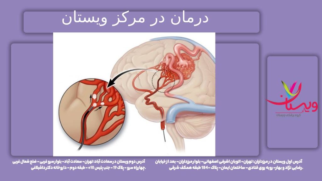 تشخیص به هنگام در گروه تخصصی ویستان درمان ناهنجاری عروقی در تهران