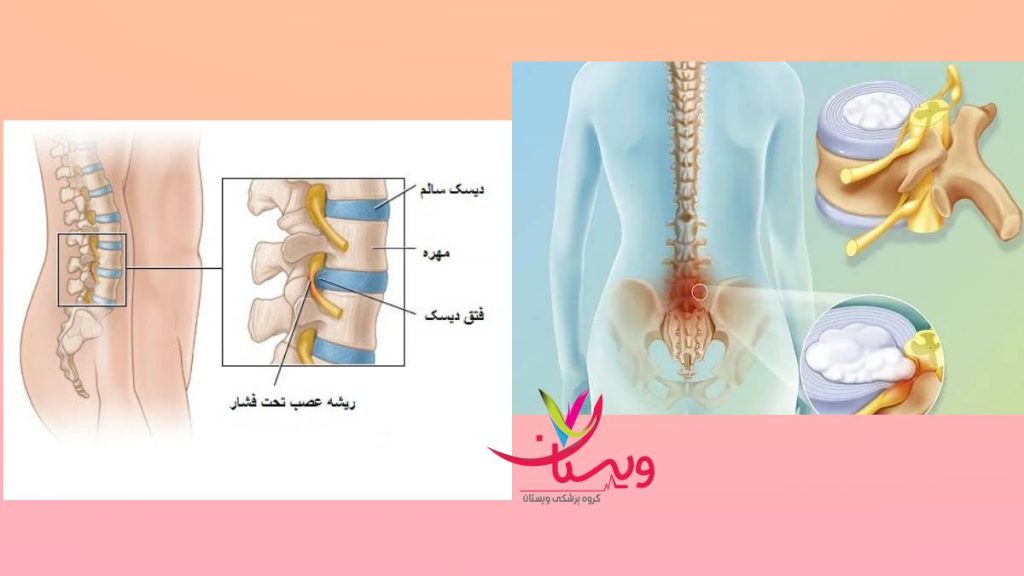متفاوت بودن درد عمل با سایر دردها فرق داشتن درد عمل دیسک کمر با درد عود