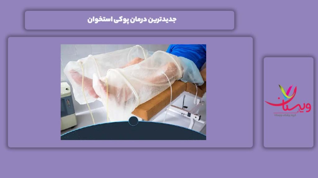 درمان پوکی استخوان در دوران یائسگی روش درمانی جدید بانوان یائسهشده