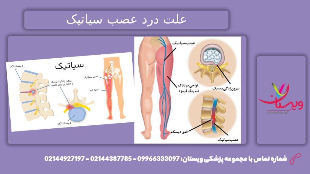 بررسی درد بیماری عصب سیاتیک