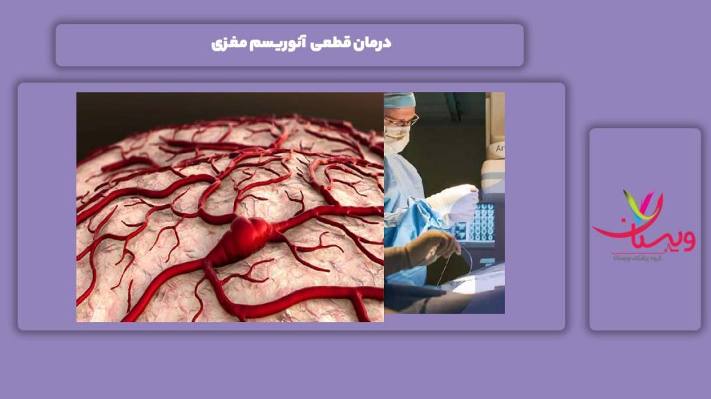درمان قطعی بیماری آنوریسم در مغز درمانن قطعی بیماری آنوریسم مغز