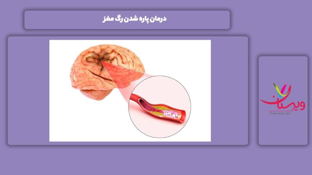 درمان پاره شدن رگ مغز درمان پاره شدن رگ در مغز