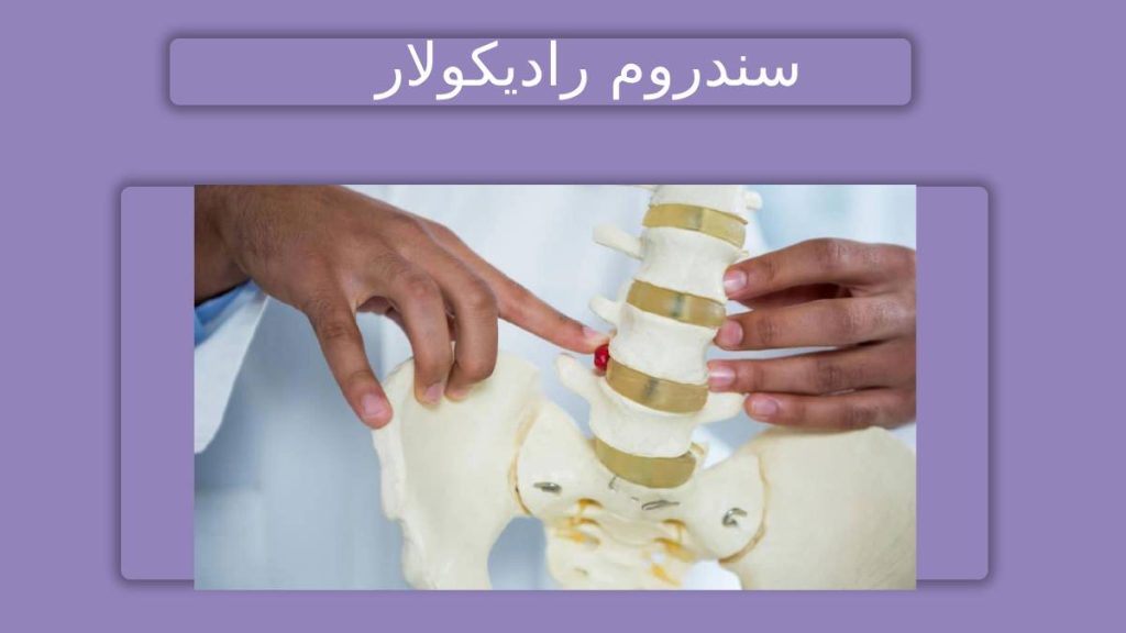 رادیکولوپاتی در 2 سمت ستون فقرات التهاب ریشه عصبی مزمن 2 طرفه