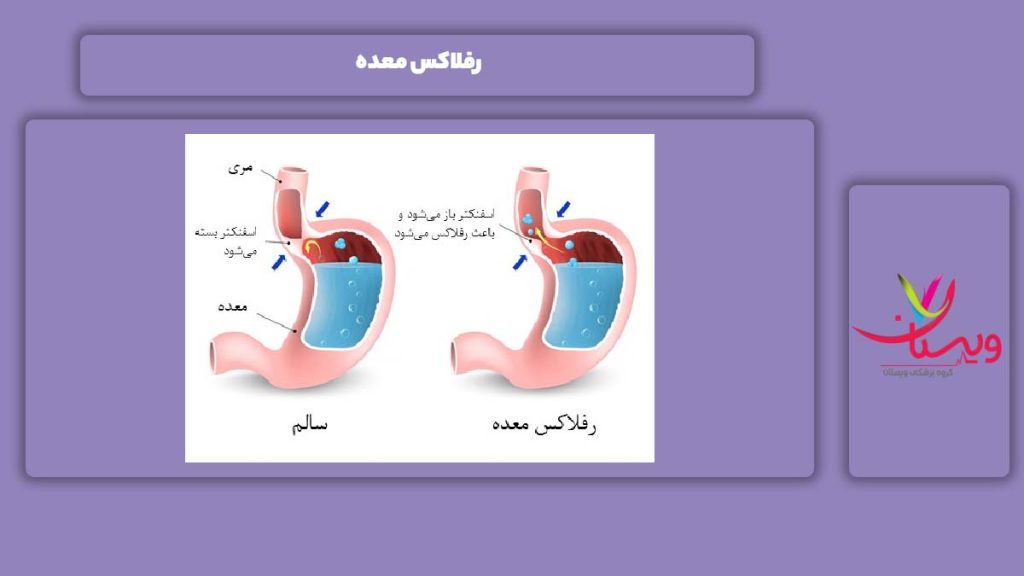 رفلاکس معده شبیه به در قلبی رفلاکس معده