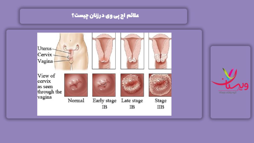 نشانه hpv در زنان علائم HPV در زنان چیست؟