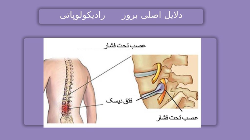 علائم اختلال عصبی مزمن نشانههای بروز مشکل عصبی ریشهای