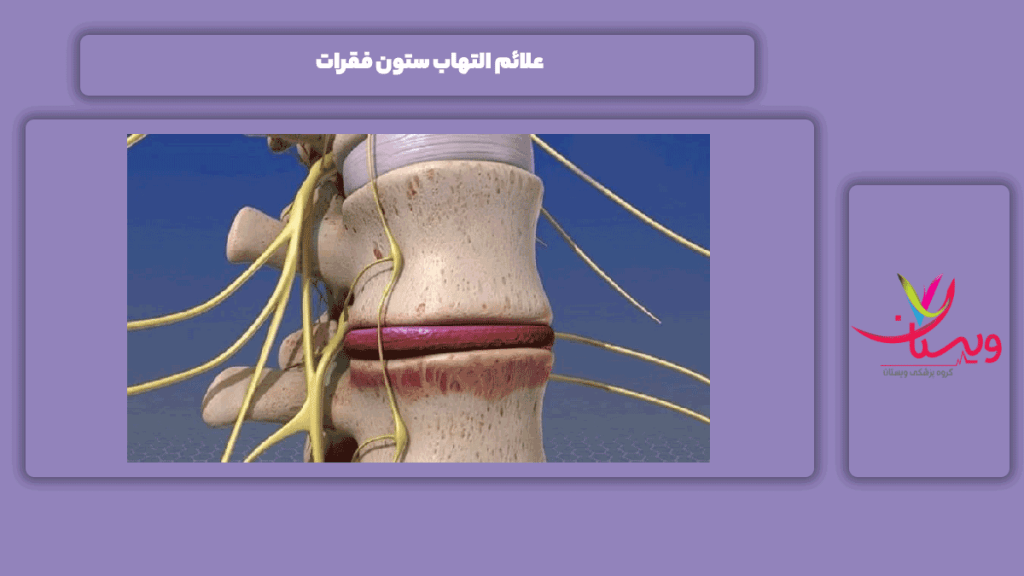 علامت التهاب ستون فقرات نشانه التهاب ستون فقرات