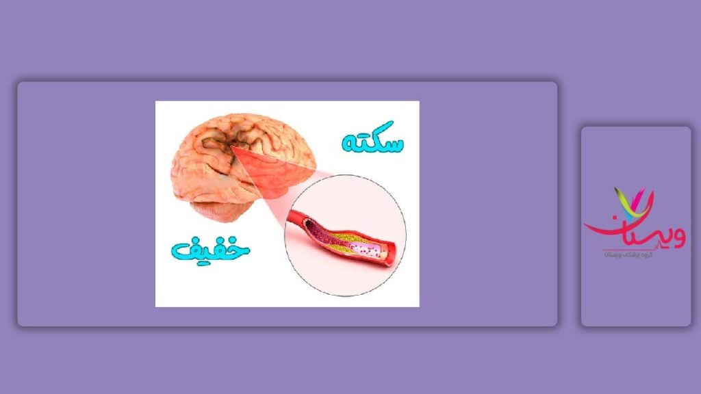 نشانه سکته مغزی خفیف بیماری سکته معزی