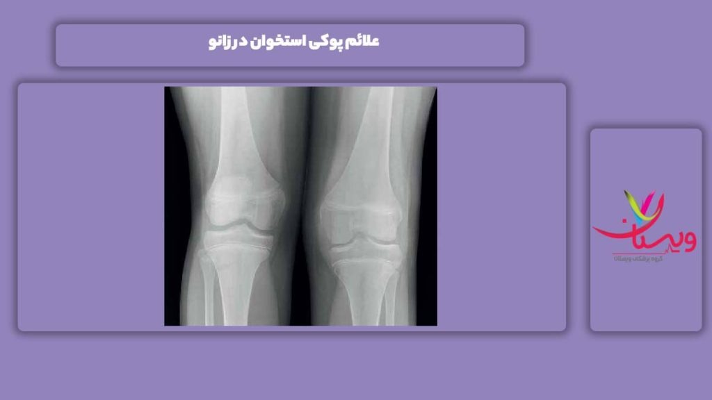 نشانه پوکی استخوان زانو نشانه پوکی استخوان در زانو