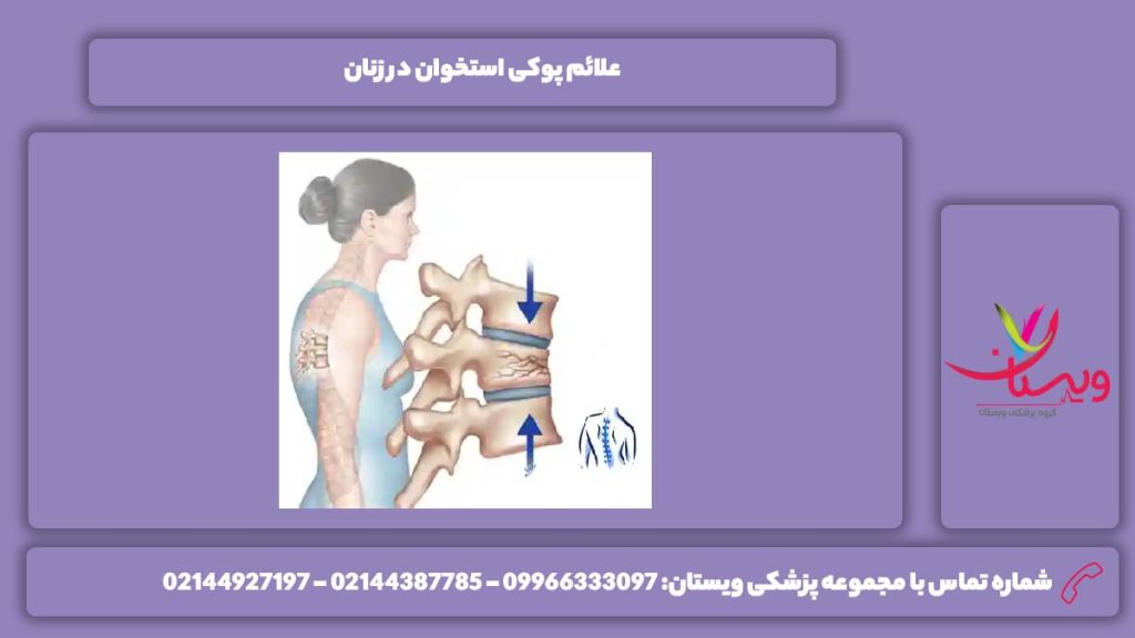 نشانه پوکی استخوان در زنان علائم تراکم استخوان