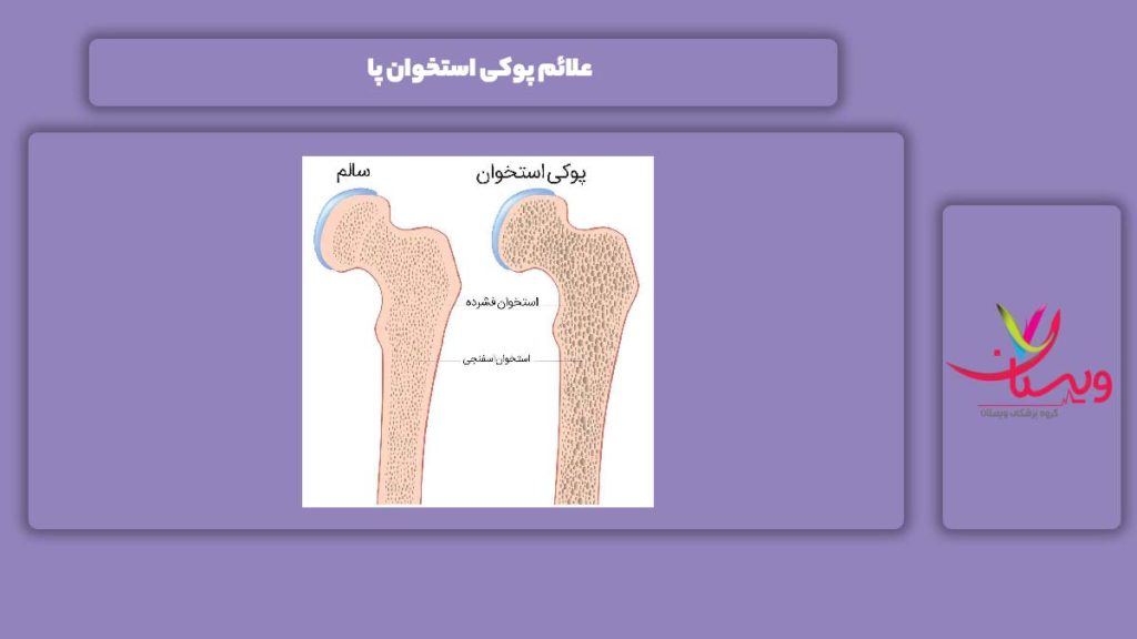 نشانه پوکی استخوان پا نشانه پوکی استخوان پاها