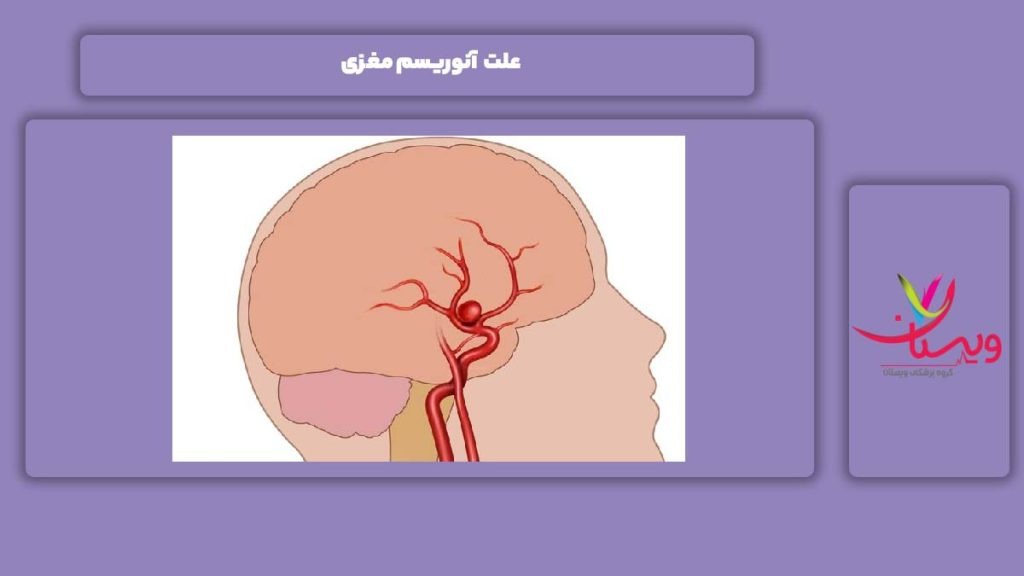 علت آنوریسم مغزی علت آنوریسم مغزی