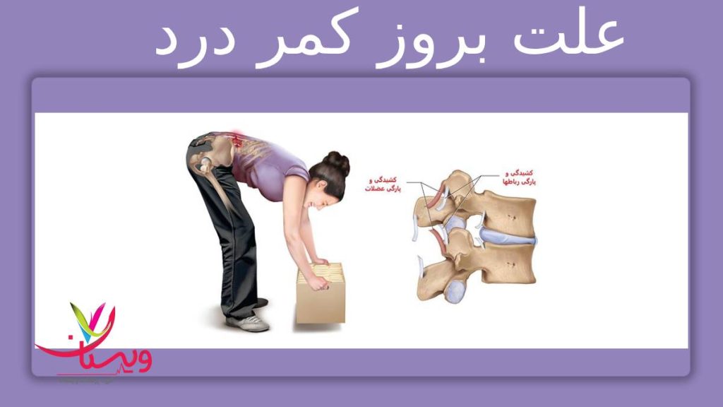 علت اصلی گرفتگی کمر علت بروز گرفتگی ناحیه کمر