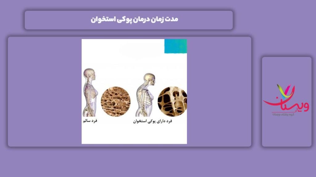 زمان درمان پوکی استخوان مدت درمان پوکی استخوان
