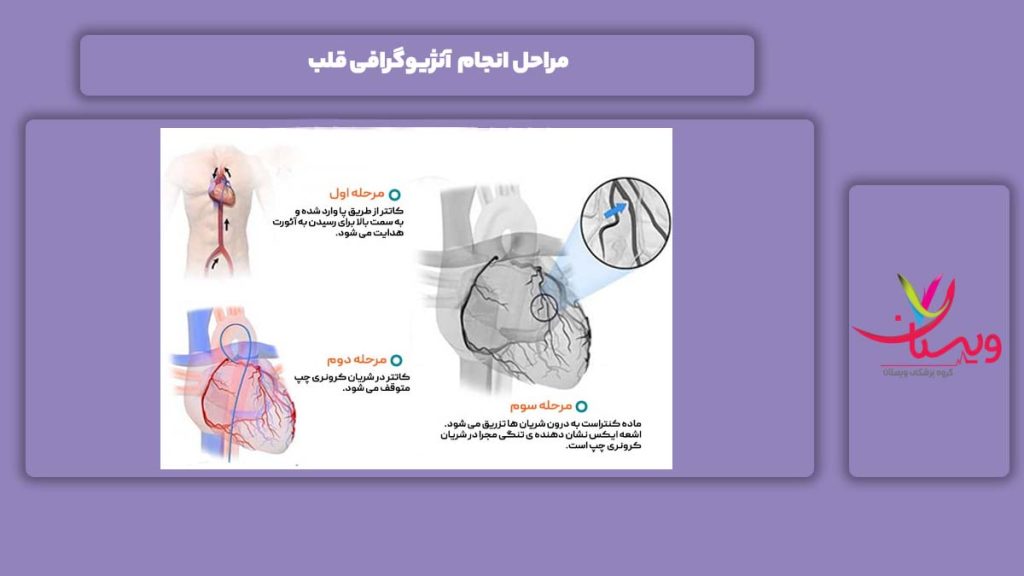 مرحلههای آنژیوگرافی قلب آنژیوگرافی قلب