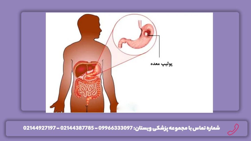 فواید تخلیه پولیپ مزیتهای درمان غیرجراحی پولیپ معده