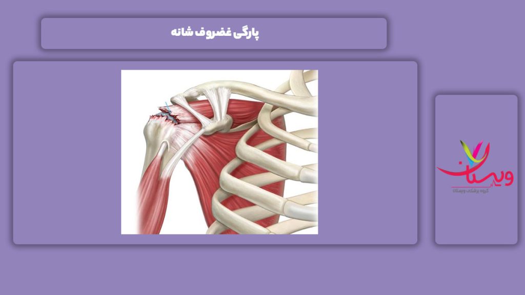 پاره شدن غضروف شانه پاره شدن غضروف در شانه