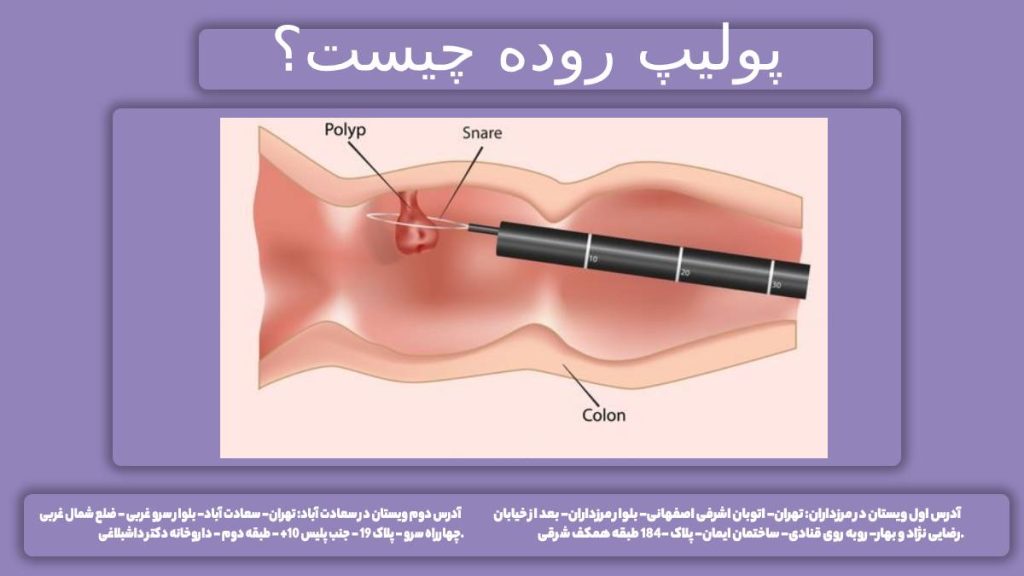 پولیپ روده بزرگ برداشتن پولیپ روده با کولونوسکوپی چیست؟