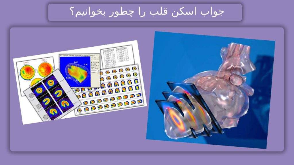 خواندن اسکن گیتد روش خواندن جواب اسکن هسته ای قلب