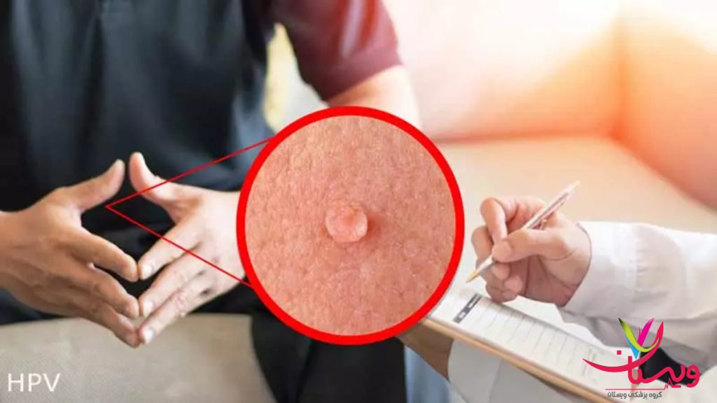 مشاوره تخصصی برای ضایعات HPV در ناحیه تناسلی بررسی ویروس HPV و زگیل تناسلی در مردان توسط پزشک متخصص
