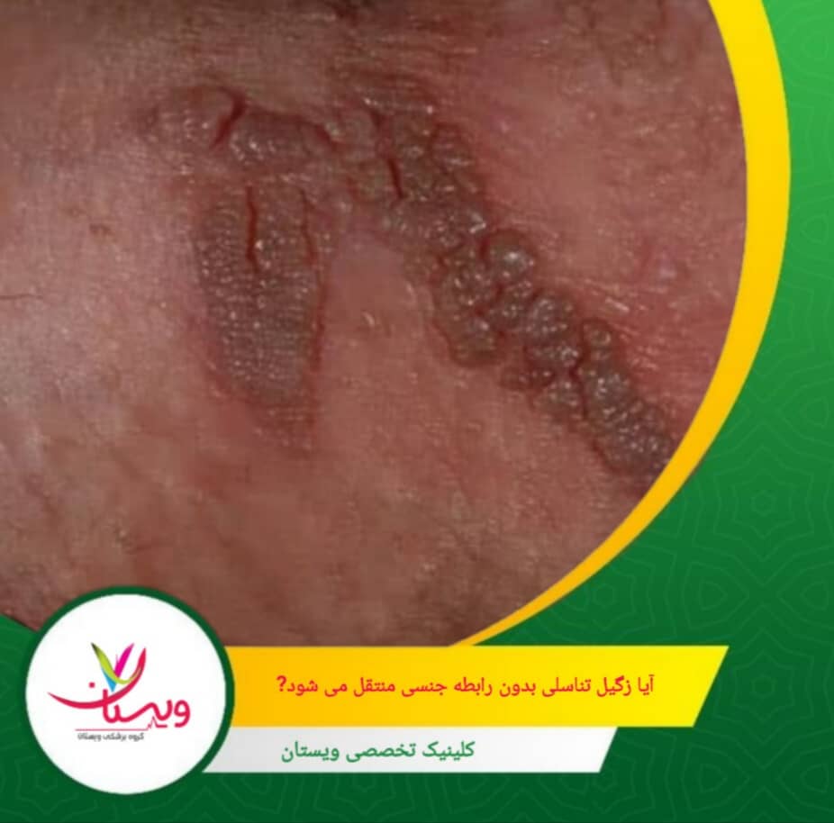 انتقال از مادر به نوزاد در زمان زایمان نیز یک راه دیگر انتقال ویروس است.( نادر) آیا زگیل تناسلی بدون رابطه جنسی منتقل میشود؟