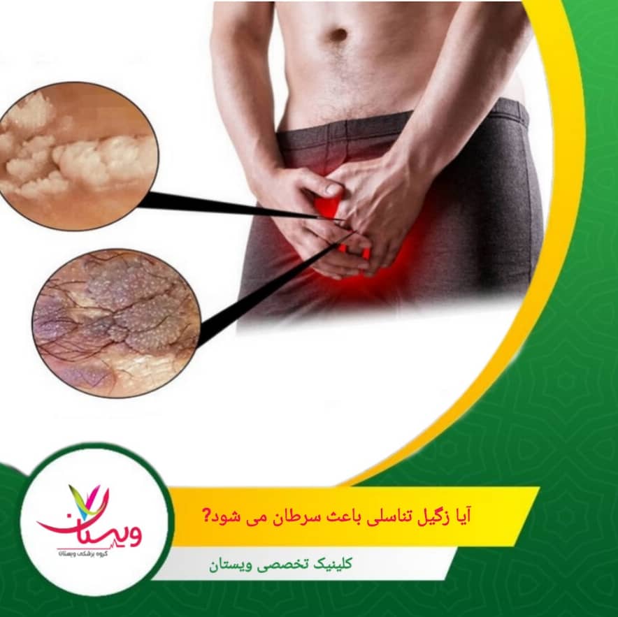 واکسیناسیون و تشخیص زودهنگام مهمترین روشهای پیشگیری از سرطانهای مرتبط با HPV هستند. آیا زگیل تناسلی باعث سرطان میشود؟