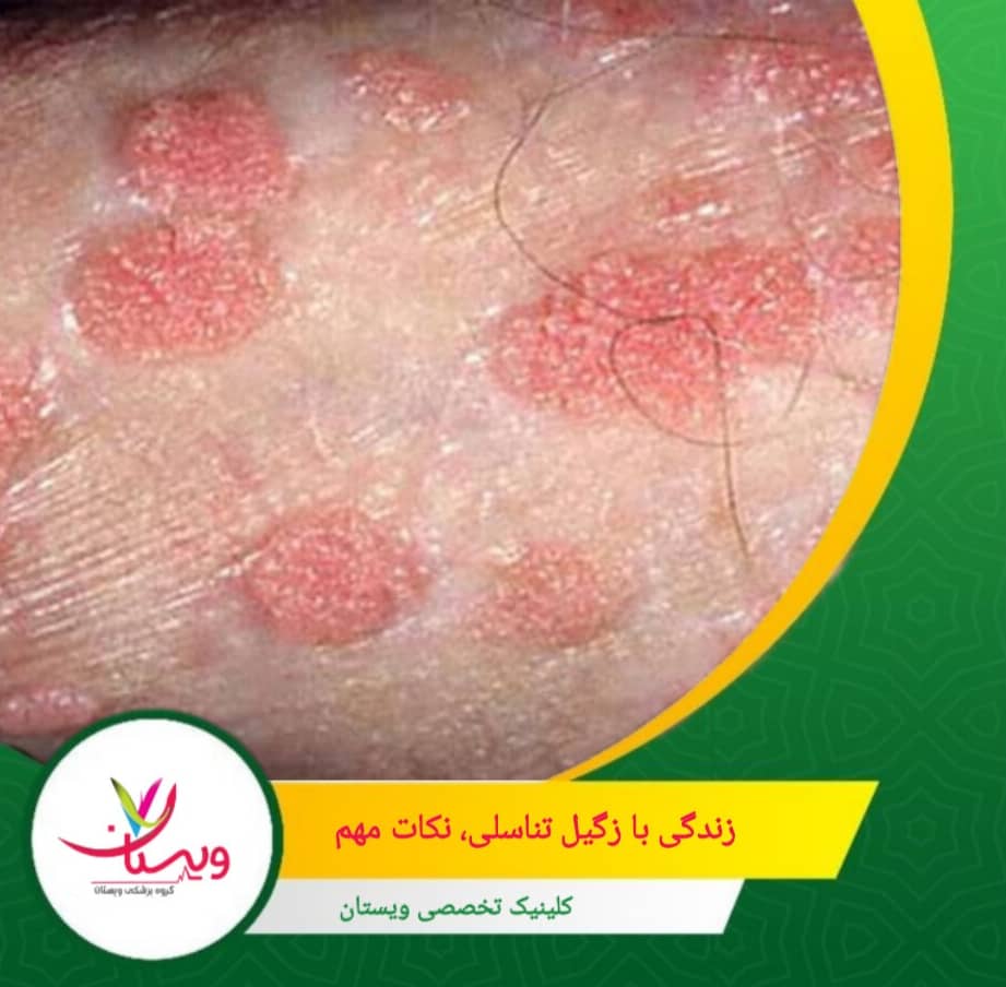 زگیل تناسلی قابل درمان است؛ حفظ آرامش به بهبود کمک میکند. زندگی با زگیل تناسلی؛ نکات مهم