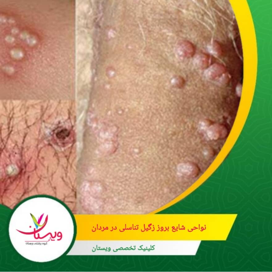 در ناحیه بین آلت و مقعد (پرینه) ناحیهای پنهان که گاهی در معاینه معمول هم دیده نمیشود. نواحی شایع بروز زگیل تناسلی در مردان