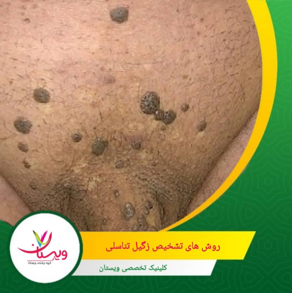 در مواردی که زائده مشکوک به سرطان یا غیرعادی باشد، پزشک ممکن است نمونهبرداری کرده و آن را به آزمایشگاه بفرستد. روشهای تشخیص زگیل تناسلی