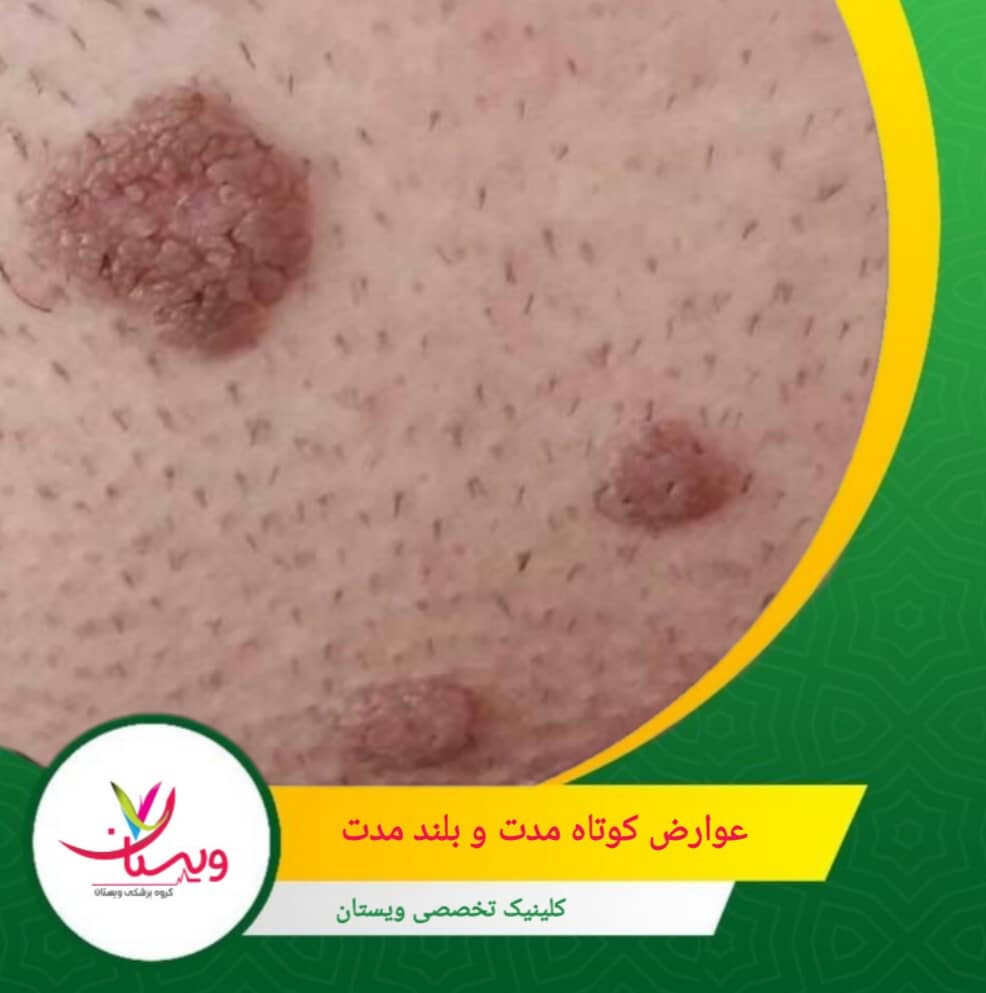 احتمال عود مجدد زگیلها حتی پس از درمان به دلیل ماندگاری ویروس در بدن. عوارض کوتاهمدت و بلندمدت