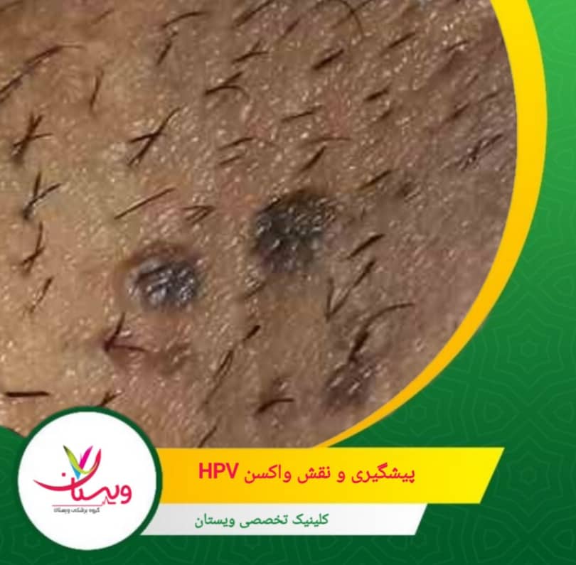 واکسن HPV با هدف مقابله با انواع پرخطر ویروس، به ویژه آنهایی که بیشترین احتمال ایجاد زگیل تناسلی و سرطان دهانه رحم را دارند. پیشگیری و نقش واکسن HPV
