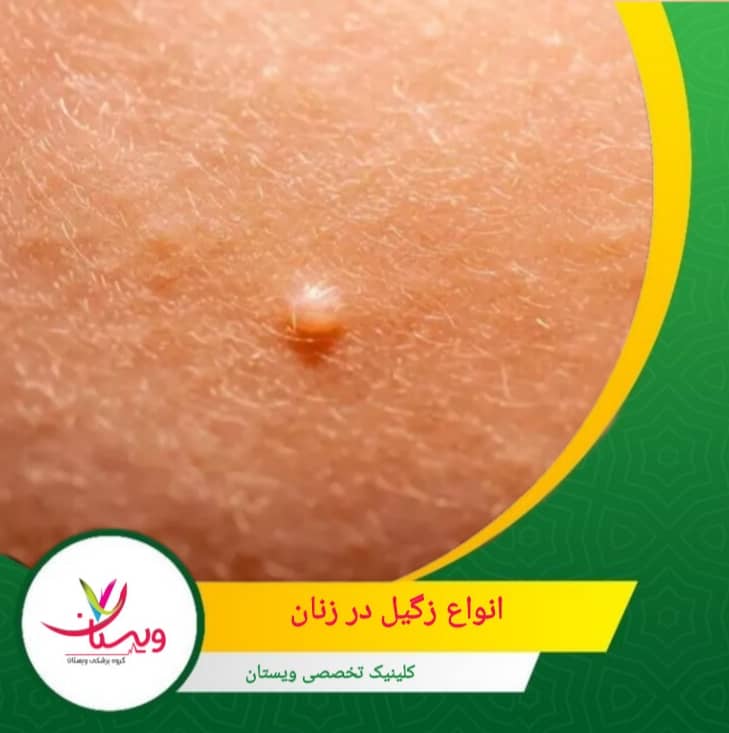 در مواردی نادر، HPV میتواند از طریق تماس دهانی منتقل شده و منجر به ایجاد زگیل در ناحیه دهان، لبها یا گلو شود. انواع زگیل تناسلی