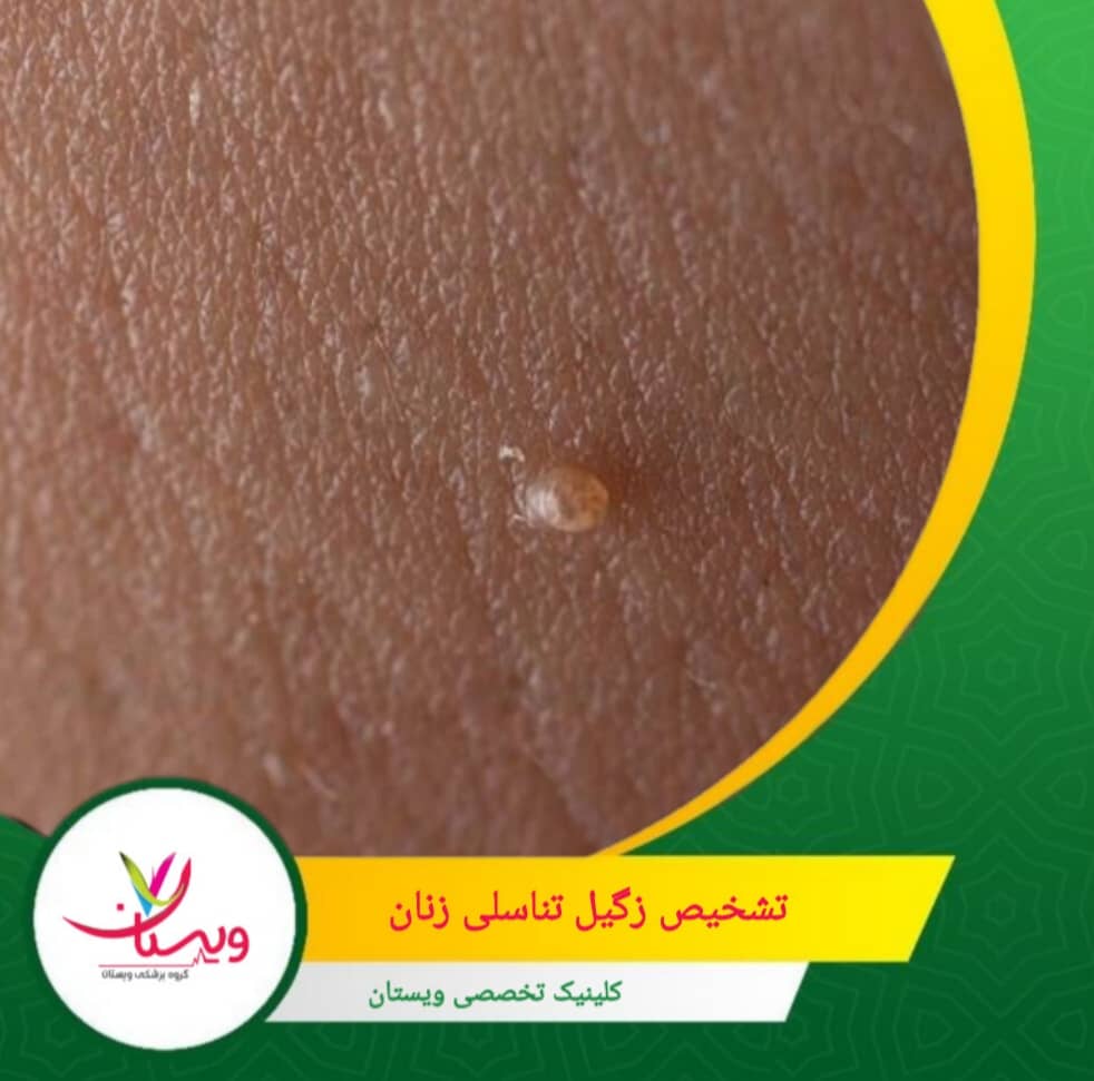 تشخیص زودهنگام کمک به پیشگیری از عوارض: از جمله گسترش زگیلها و خطرات مرتبط با انواع پرخطر HPV. تشخیص زگیل تناسلی زنان